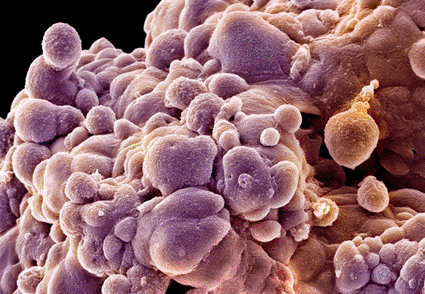 Image: Colored scanning electron micrograph (SEM) of prostate cancer cells (Photo courtesy of David McCarthy / SPL).